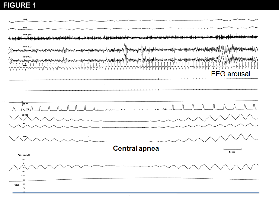 Basics Of Sleep Apnea And Heart Failure - American College Of Cardiology